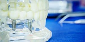 Имплантаты за один день