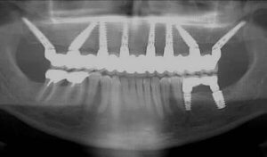 Зубные имплантаты на 8 имплантатах - Все на 8