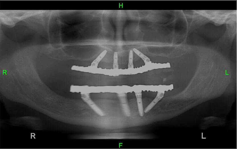 Dental implants on 4 implants - All on 4