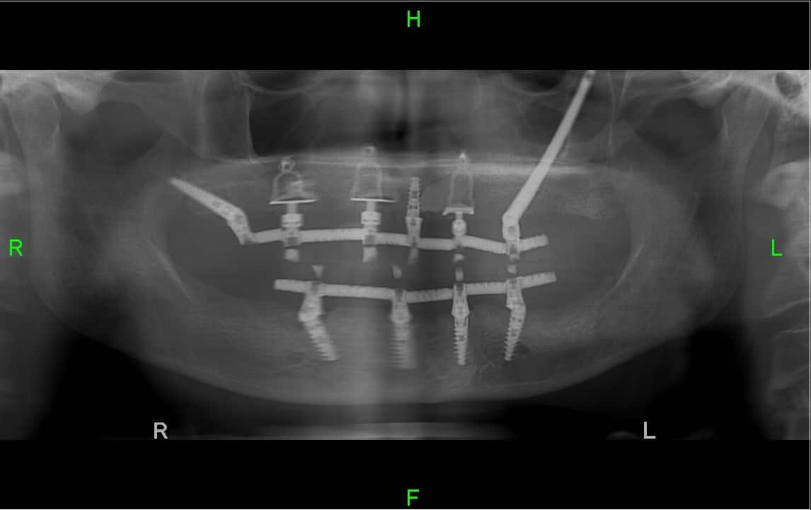 Длинные скуловые имплантаты при потере костной массы верхней челюсти