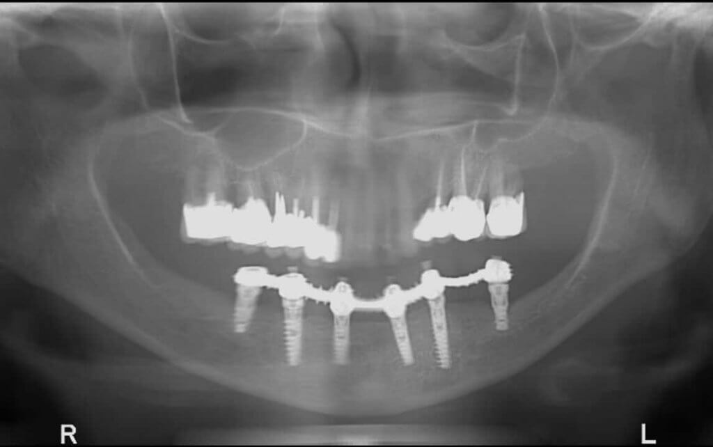 Неудачная имплантация зубов
