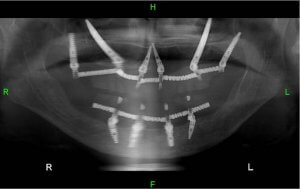 Длинные скуловые имплантаты при потере костной массы верхней челюсти