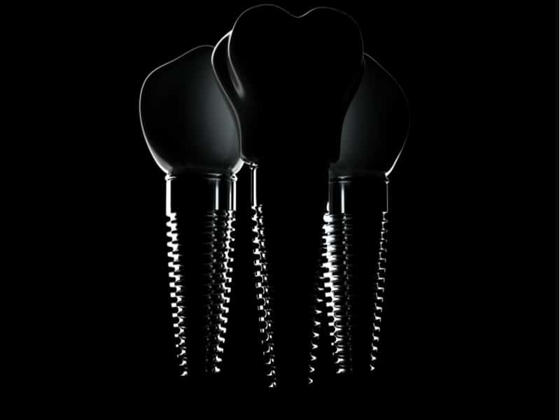 רדיו חיפה האזנה לתכנית על השתלות שיניים