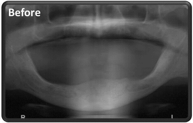 השתלת שיניים במקרה של חוסר עצם בלסת התחתונה