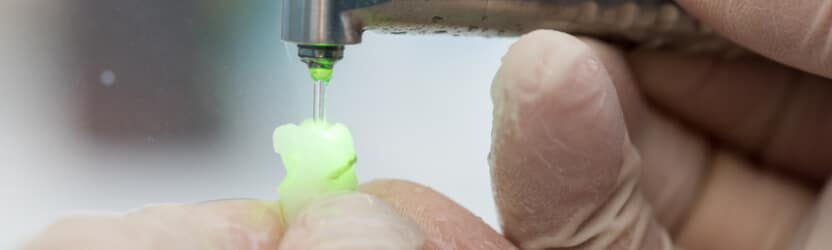 השתלת שיניים בלייזר