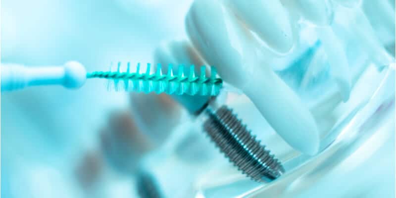 תחזוקת שתל דנטלי