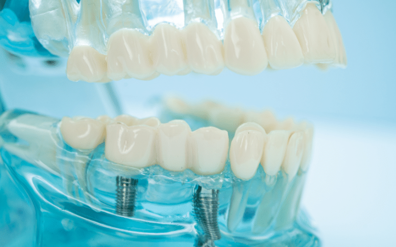 שיניים זמניות