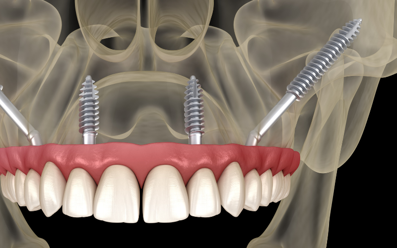 שתלים למחוסרי עצם - שילוב בין שתלי זיגומה לשתלים קצרים