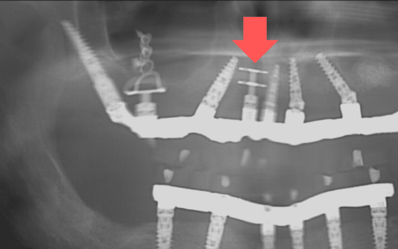 שתלים למחוסרי עצם - שתל דיסק