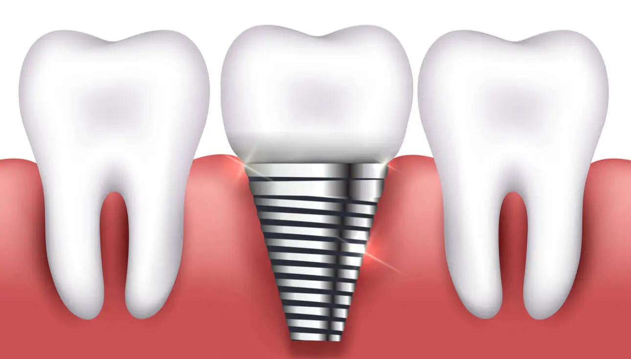same-day dental implants