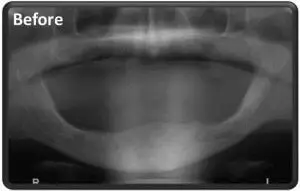 מצב קיצוני של חוסר שיניים וחוסר עצם בלסת העליונה