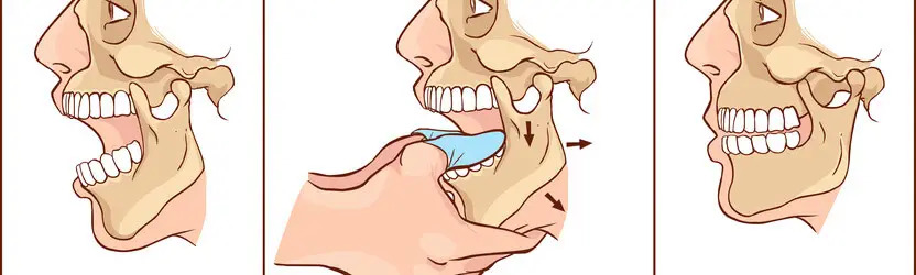 כאבי ראש ושיניים - תסמונת מפרק הלסת