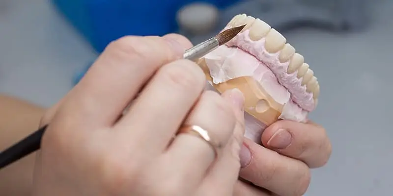 כמה עולה השתלת שיניים? מבנה ועיצוב שיניים