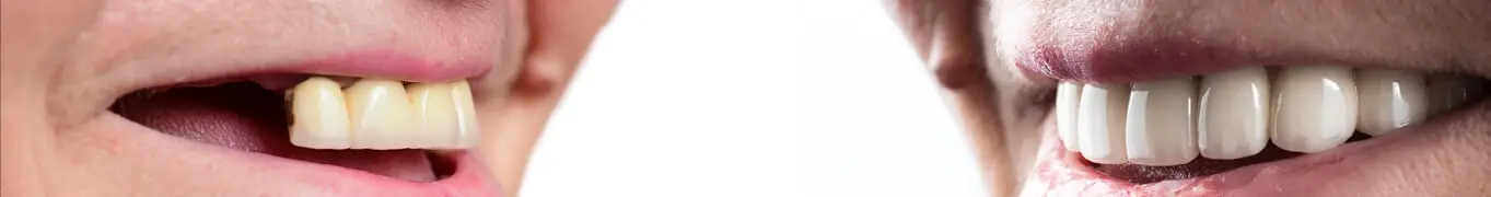 שתלים קצרים