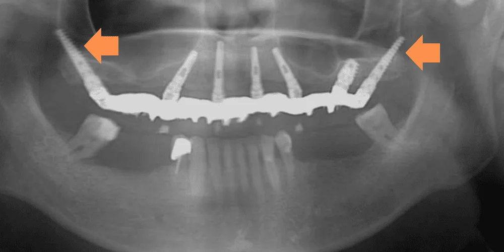 שתלים זיגומטיים ארוכים יותר