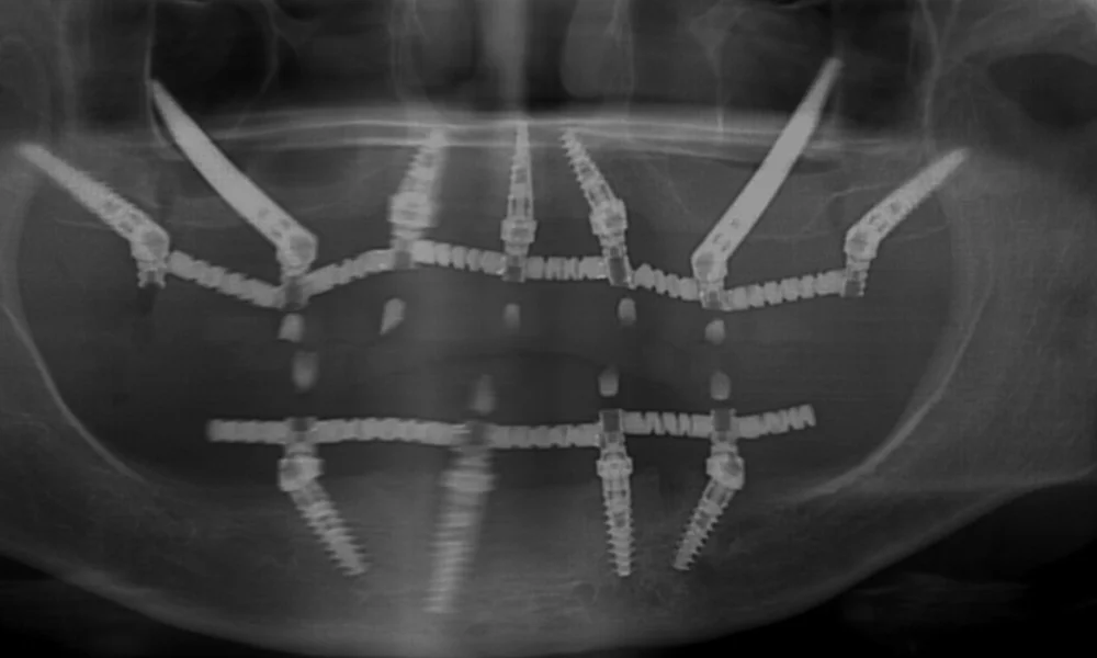 שתלים זיגומטיים