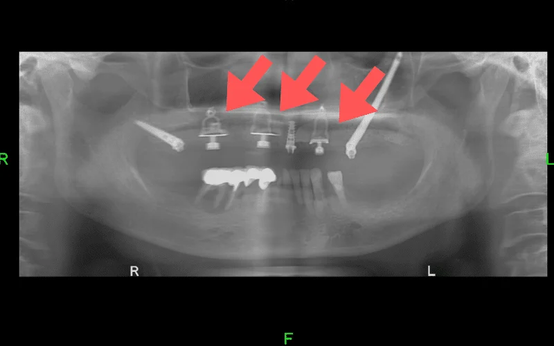 השתלה בזאלית - צילום רנטגן של שתלי דיסק